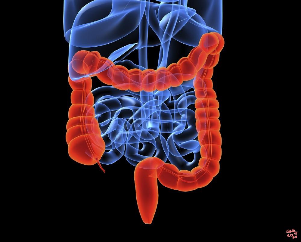 سرطان روده بزرگ