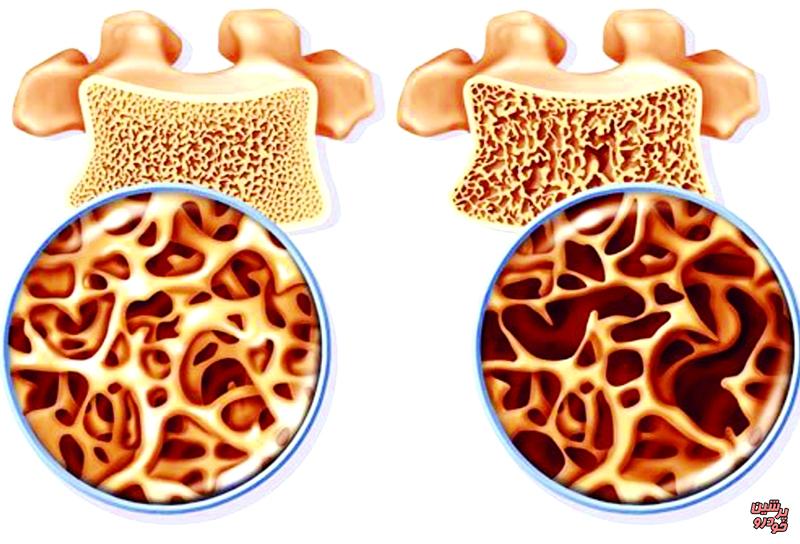 پوکی استخوان
