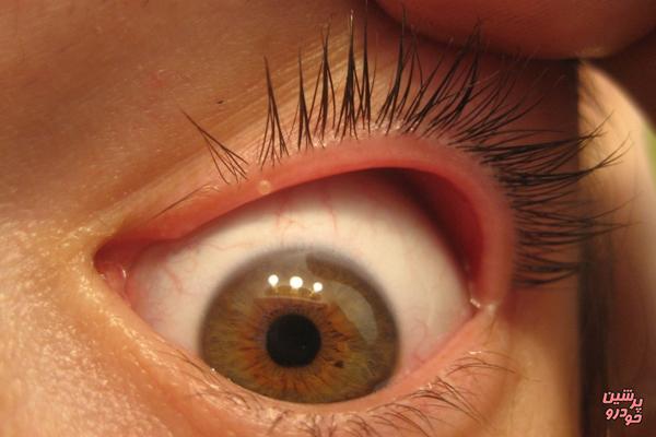 عواملی که سبب عفونت چشمی می‌شود