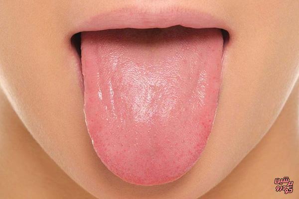 تشخیص سرطان پانکراس از طریق زبان