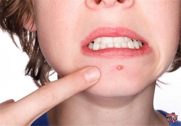 نکاتی درباره سرطان پوست 