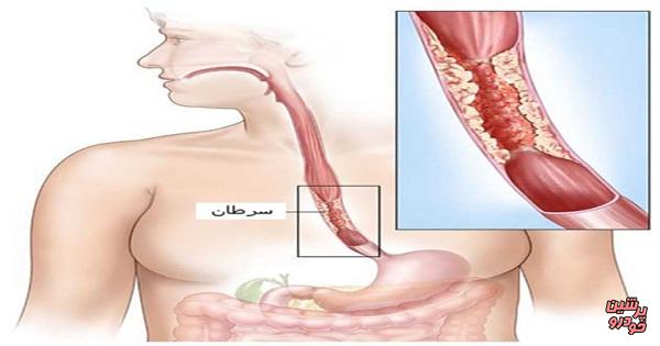 ارتباط بیماری لثه با سرطان مری 