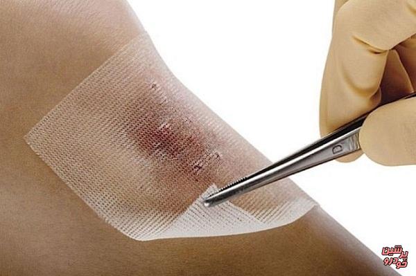 تولید پانسمان پلیمری برای ترمیم زخم