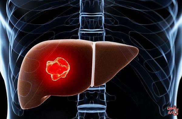 ارتباط کپک نان با سرطان کبد