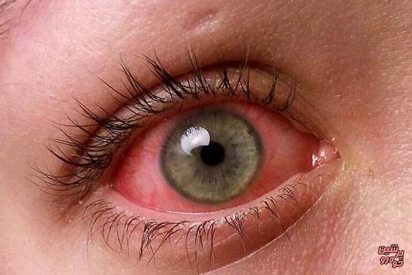 7 علامت خطرناک لکه خونی در چشم