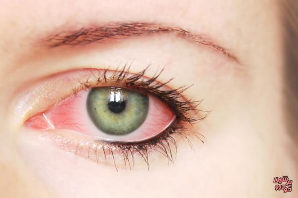 دلایل خون گرفتگی چشم‌ها چیست؟