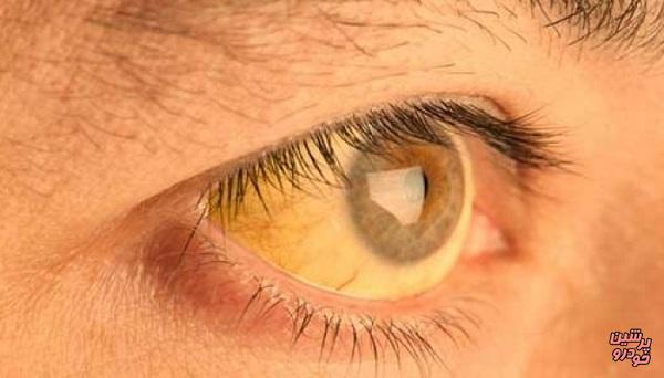 لکه‌های زرد چشم نشانه چیست؟ 